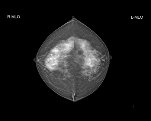 GENORAY Mammography DMX-600