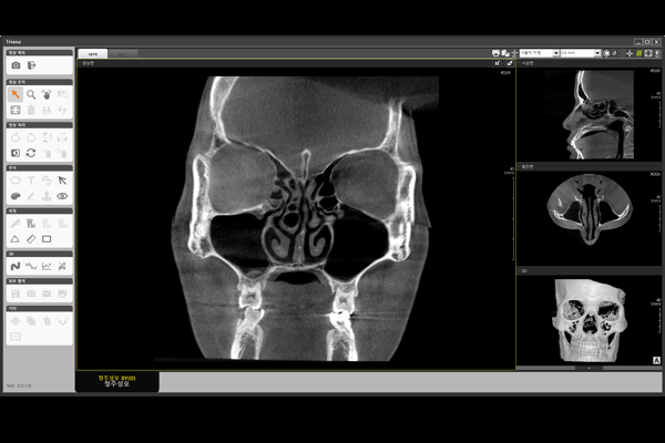 GENORAY Digital 3D CT PAPAYA 3D ENT